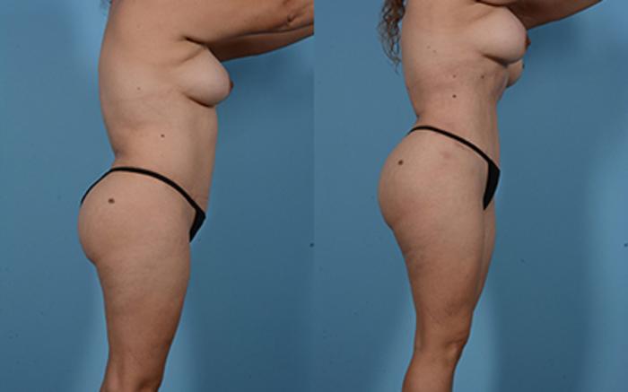Before & After Liposuction Case 94907 View 2 View in Houston, TX