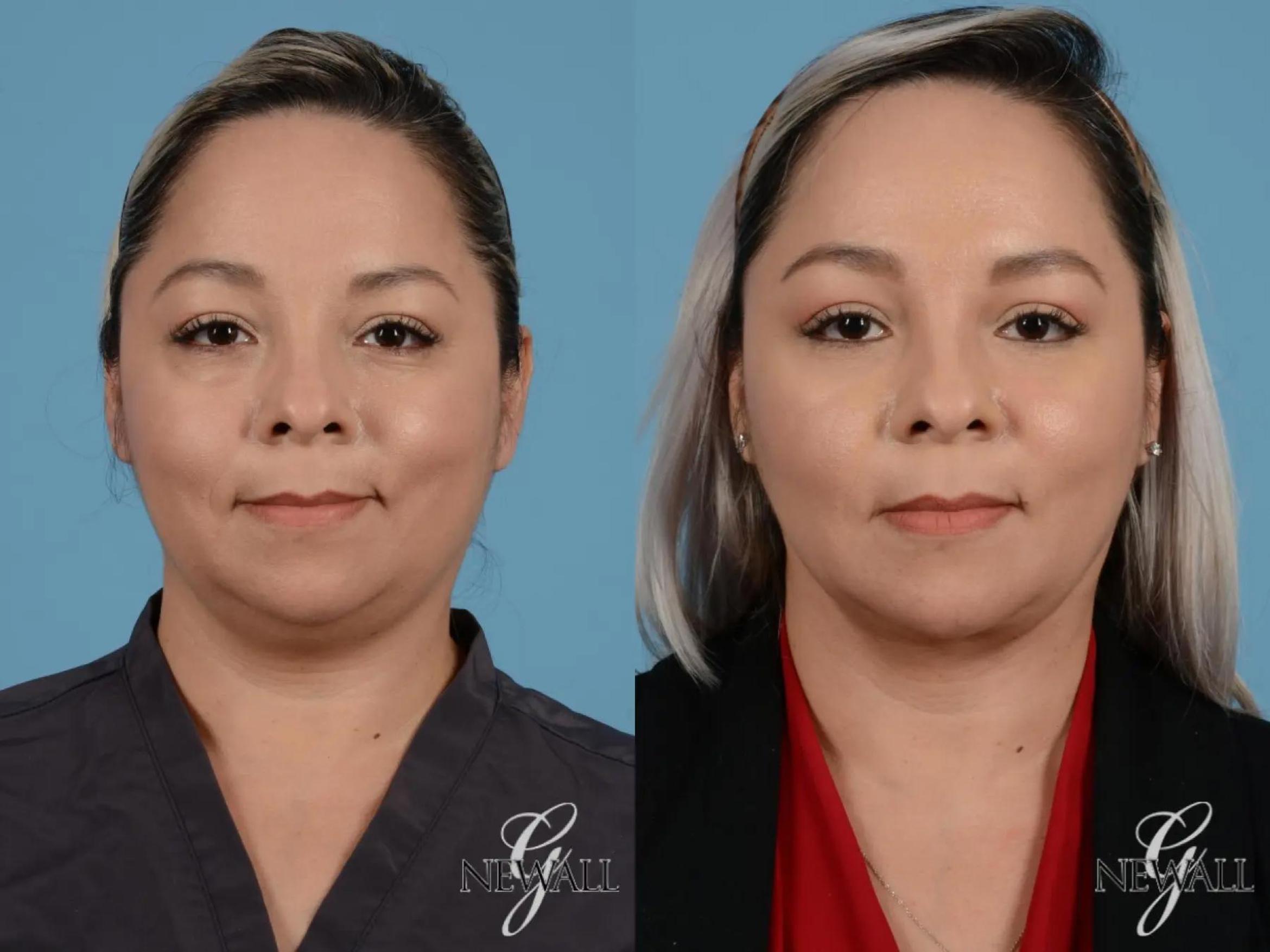 Before & After Liposuction of the Neck Case 17451 View 1 View in Houston, TX