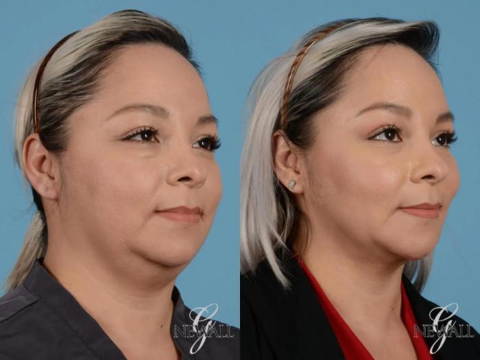 Before & After Liposuction of the Neck Case 17451 View 2 View in Houston, TX