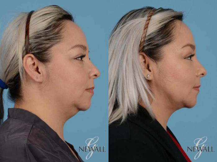 Before & After Liposuction of the Neck Case 17451 View 3 View in Houston, TX