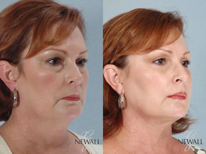 Before & After Liposuction of the Neck Case 17457 View 2 View in Houston, TX