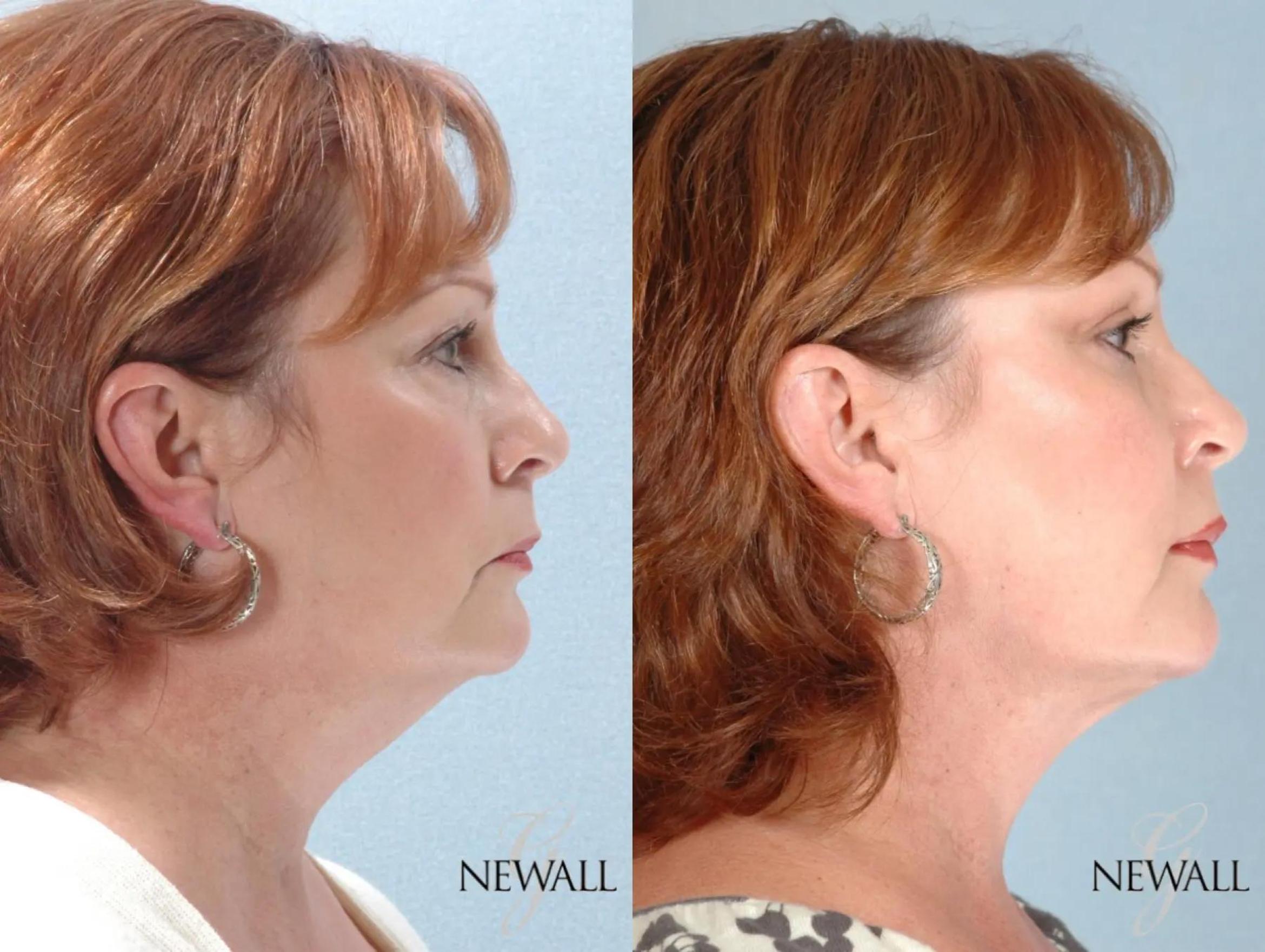 Before & After Liposuction of the Neck Case 17457 View 3 View in Houston, TX