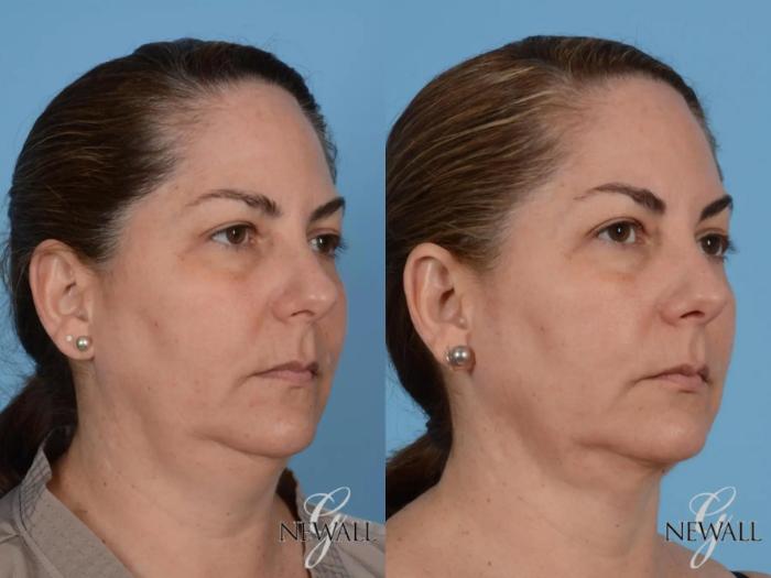 Before & After Liposuction of the Neck Case 17562 View 2 View in Houston, TX