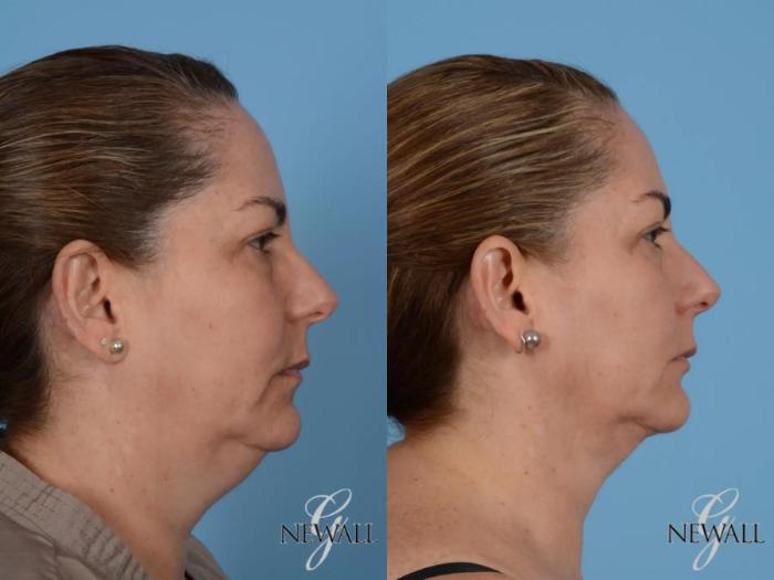 Before & After Liposuction of the Neck Case 17562 View 3 View in Houston, TX