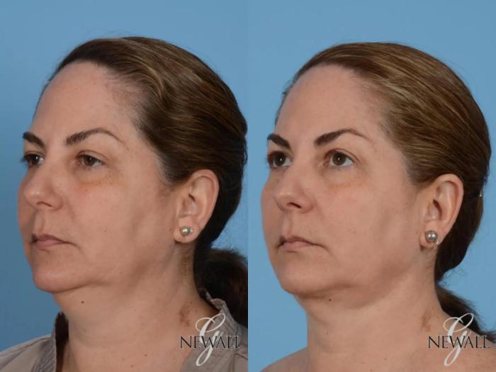 Before & After Liposuction of the Neck Case 17562 View 4 View in Houston, TX