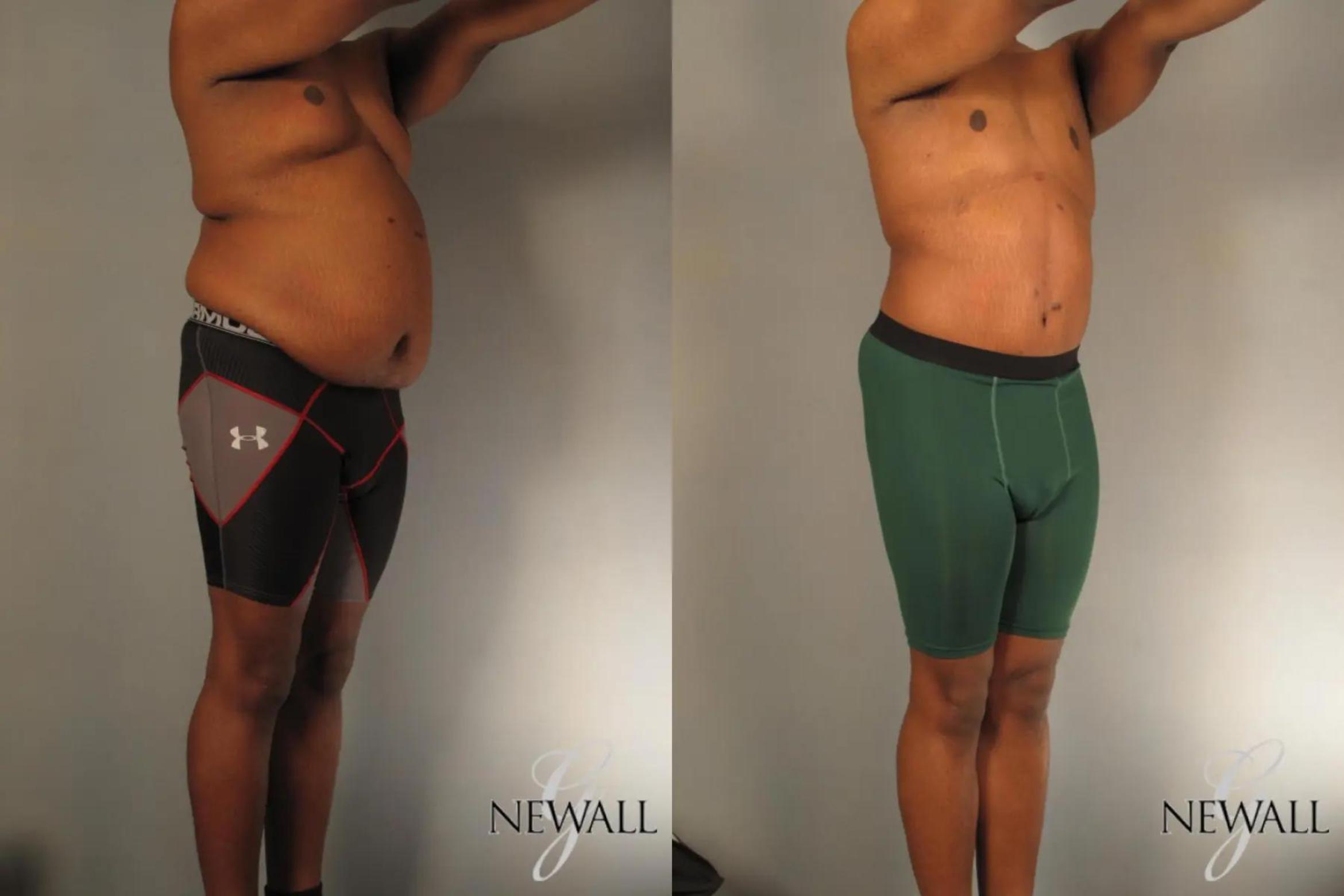 Before & After Male Tummy Tuck For Men Case 17812 View 2 View in Houston, TX