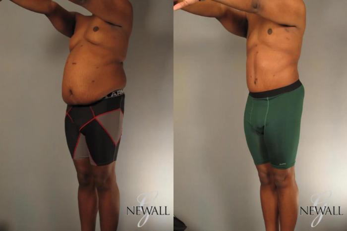 Before & After Male Tummy Tuck For Men Case 17812 View 4 View in Houston, TX