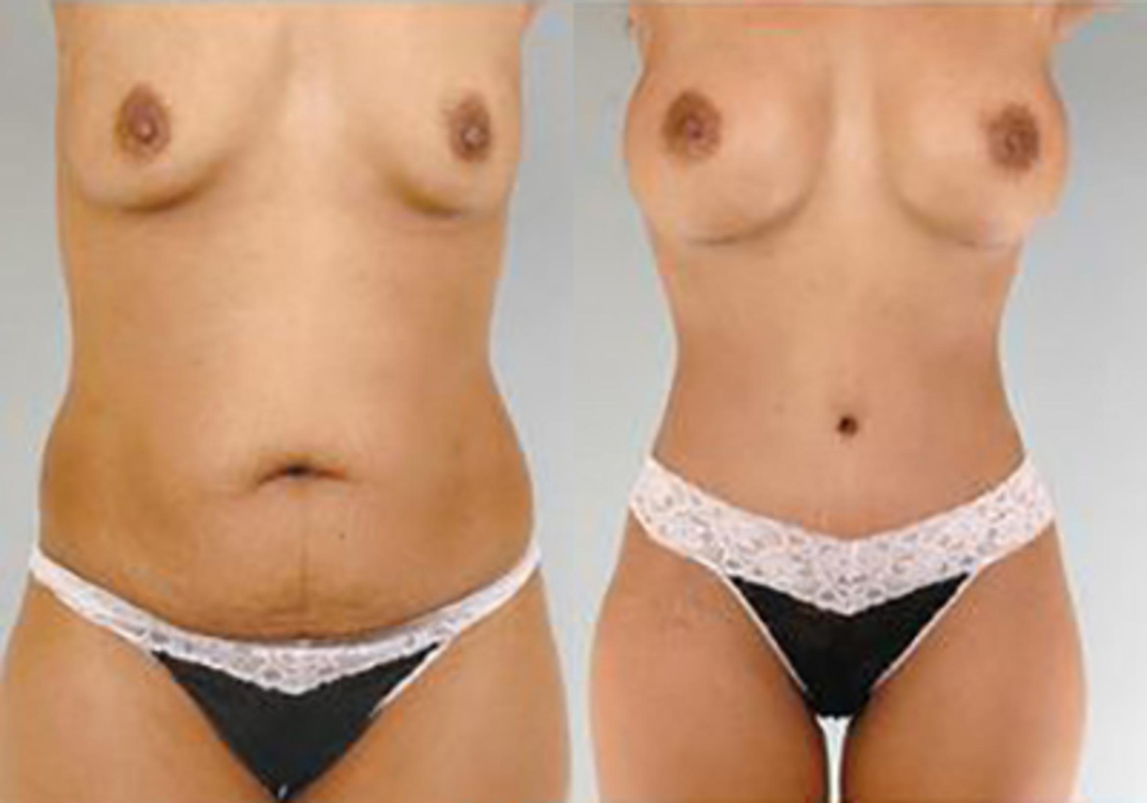 Before & After Mommy Makeover Case 100 View 1 View in Houston, TX