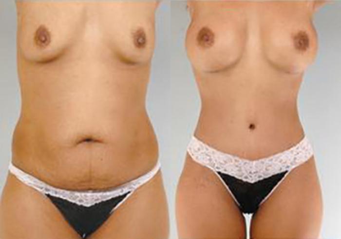 Before & After Mommy Makeover Case 100 View 1 View in Houston, TX