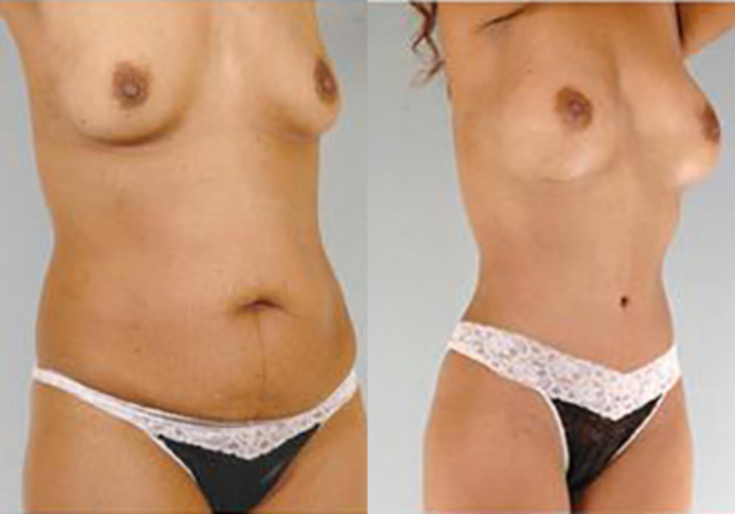 Before & After Mommy Makeover Case 100 View 2 View in Houston, TX