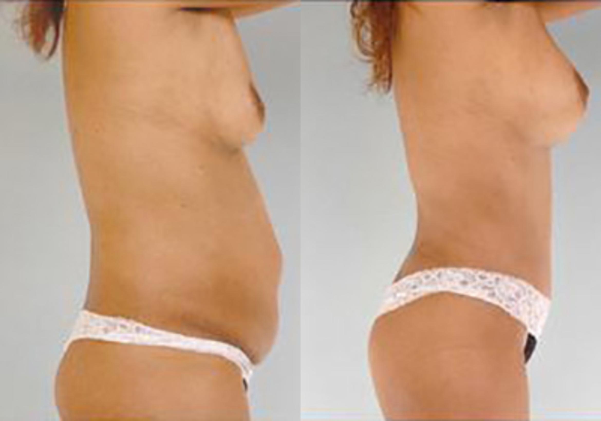 Before & After Mommy Makeover Case 100 View 3 View in Houston, TX