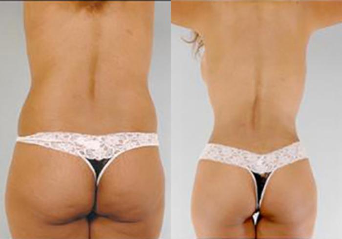 Before & After Mommy Makeover Case 100 View 4 View in Houston, TX