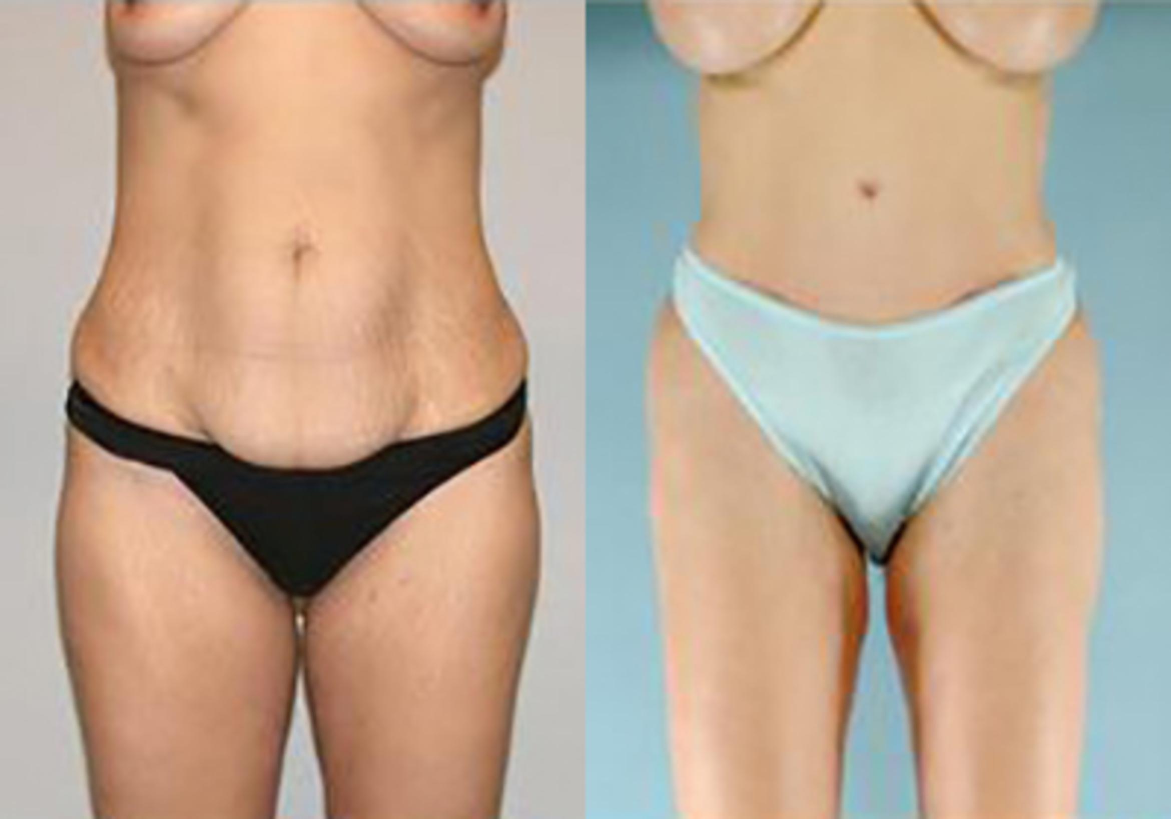 Before & After Mommy Makeover Case 101 View 1 View in Houston, TX