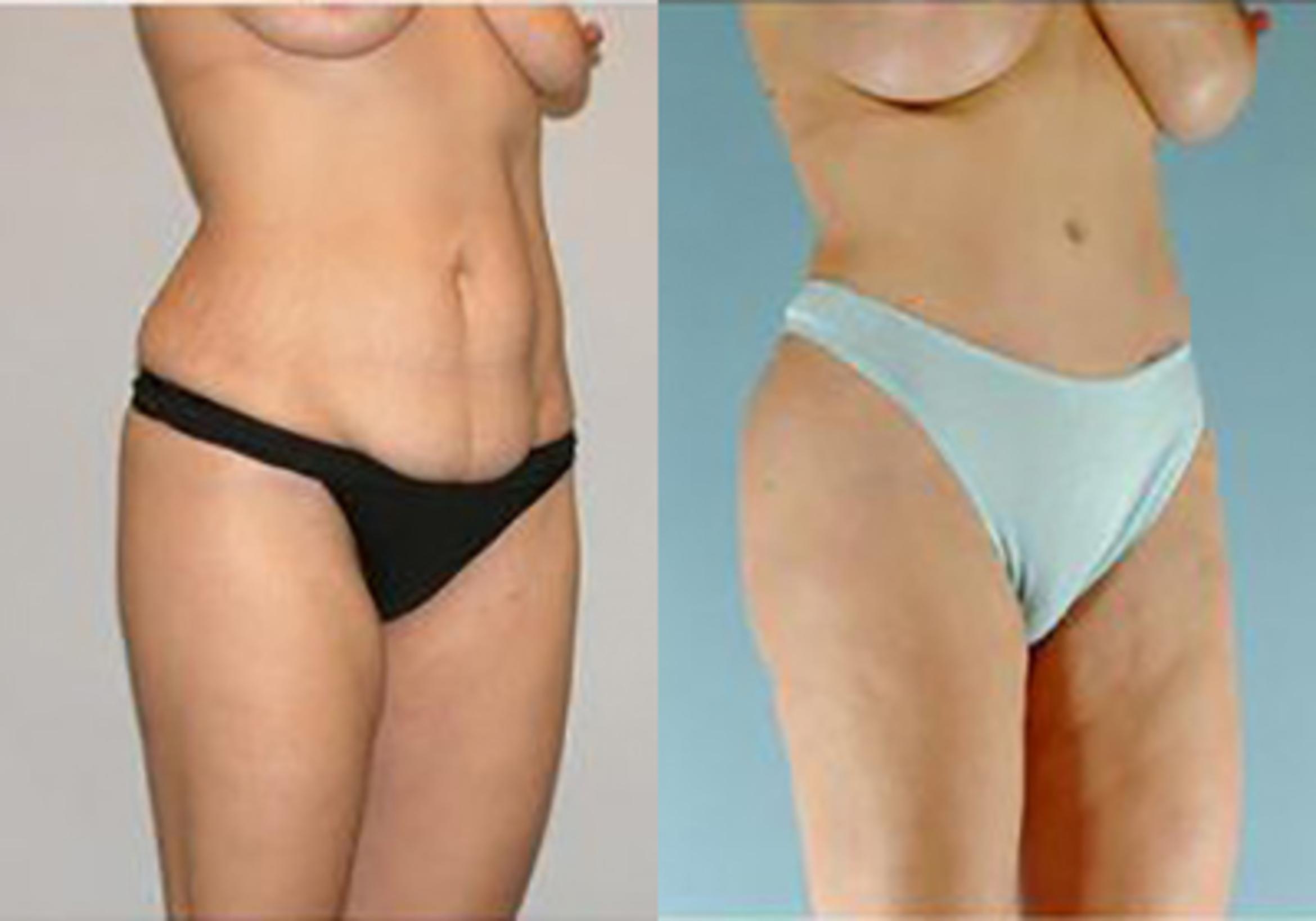 Before & After Mommy Makeover Case 101 View 2 View in Houston, TX