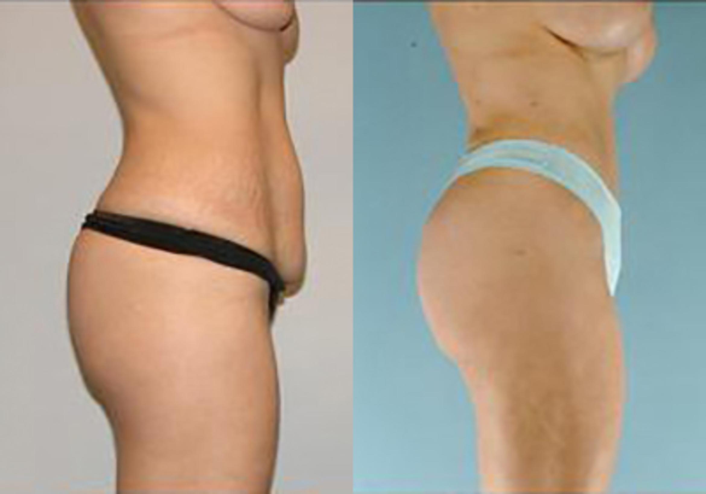 Before & After Mommy Makeover Case 101 View 3 View in Houston, TX