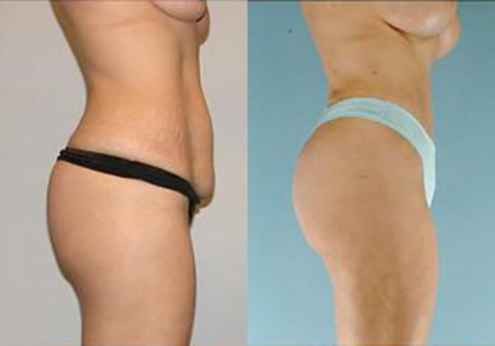 Before & After Mommy Makeover Case 101 View 3 View in Houston, TX