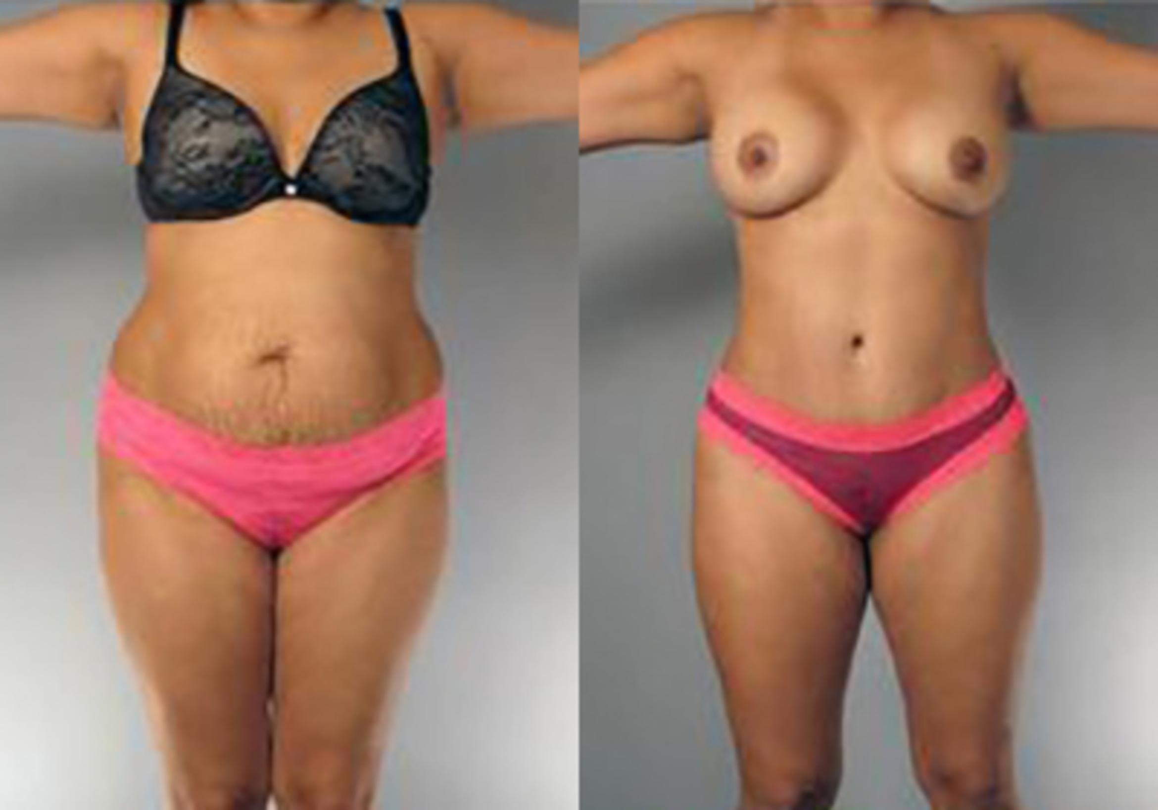 Before & After Mommy Makeover Case 102 View 1 View in Houston, TX