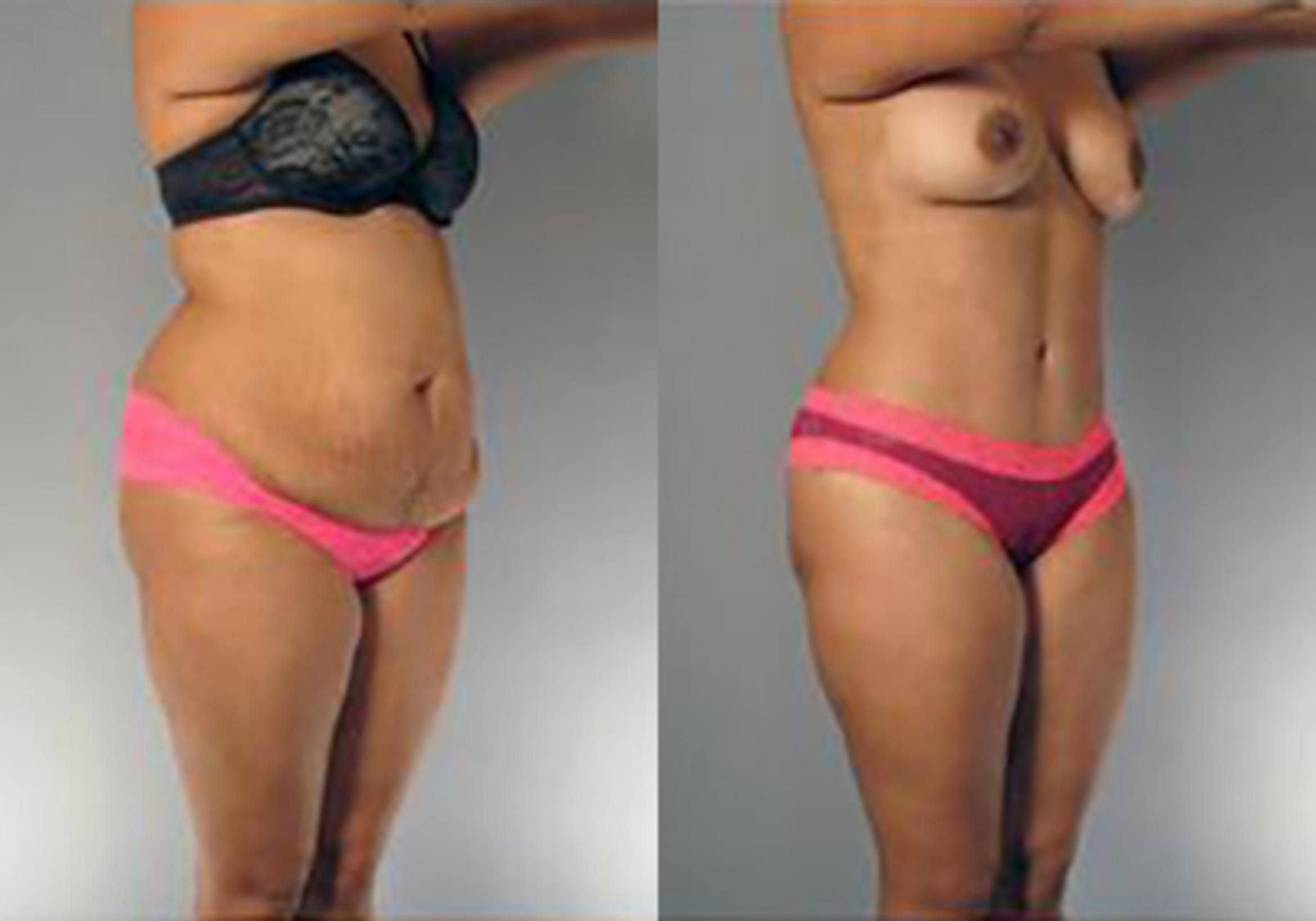 Before & After Mommy Makeover Case 102 View 2 View in Houston, TX