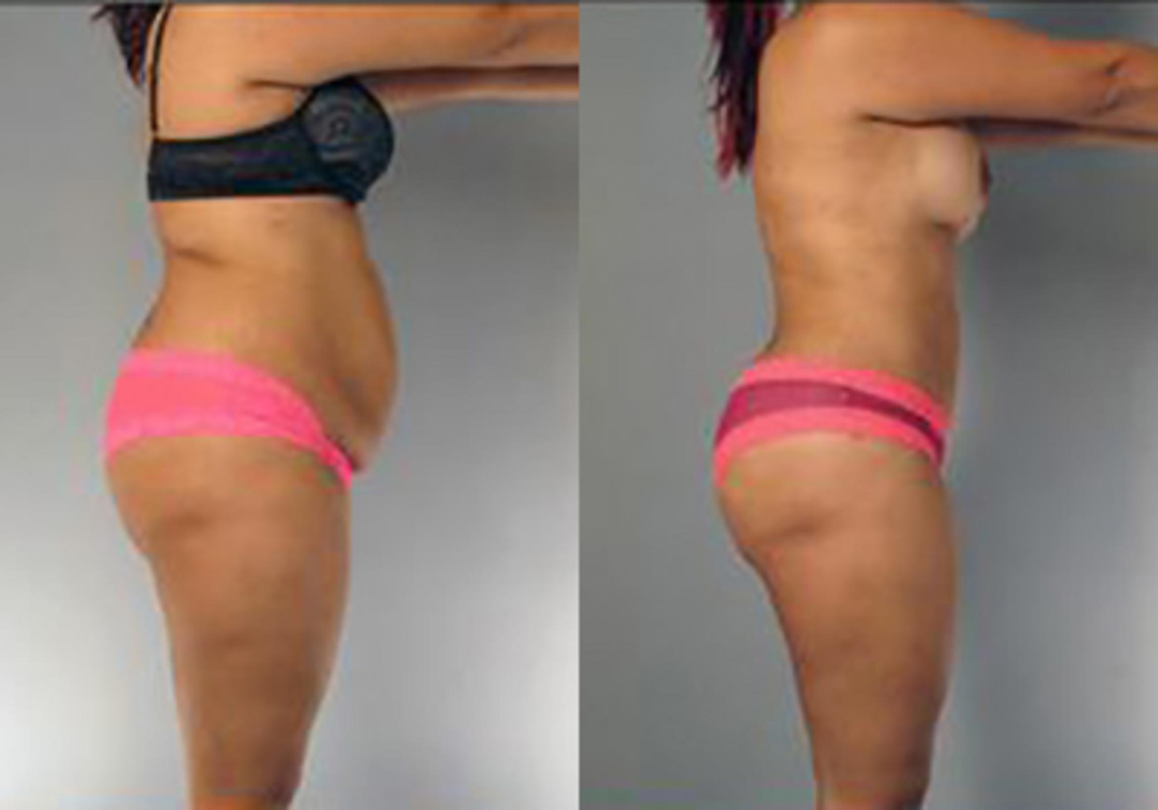 Before & After Mommy Makeover Case 102 View 3 View in Houston, TX