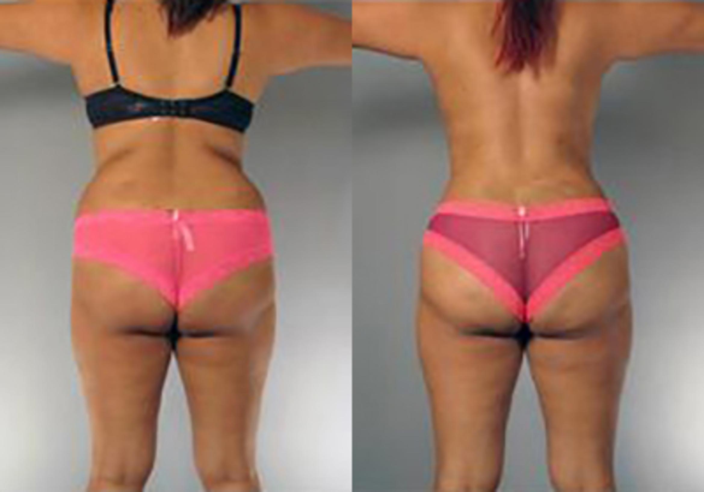 Before & After Mommy Makeover Case 102 View 4 View in Houston, TX