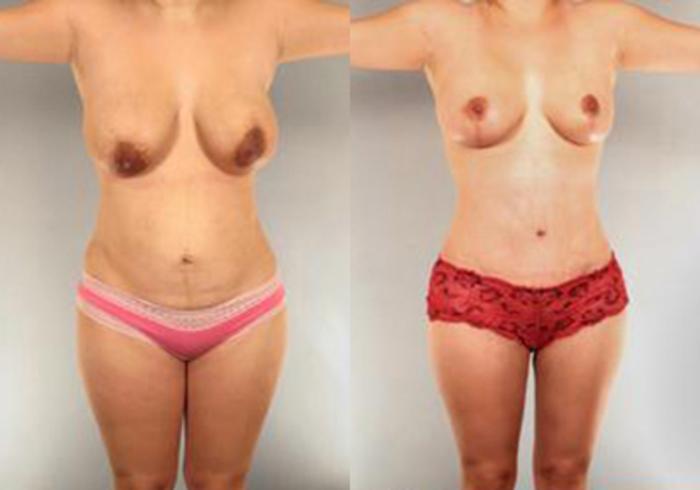 Before & After Mommy Makeover Case 103 View 1 View in Houston, TX