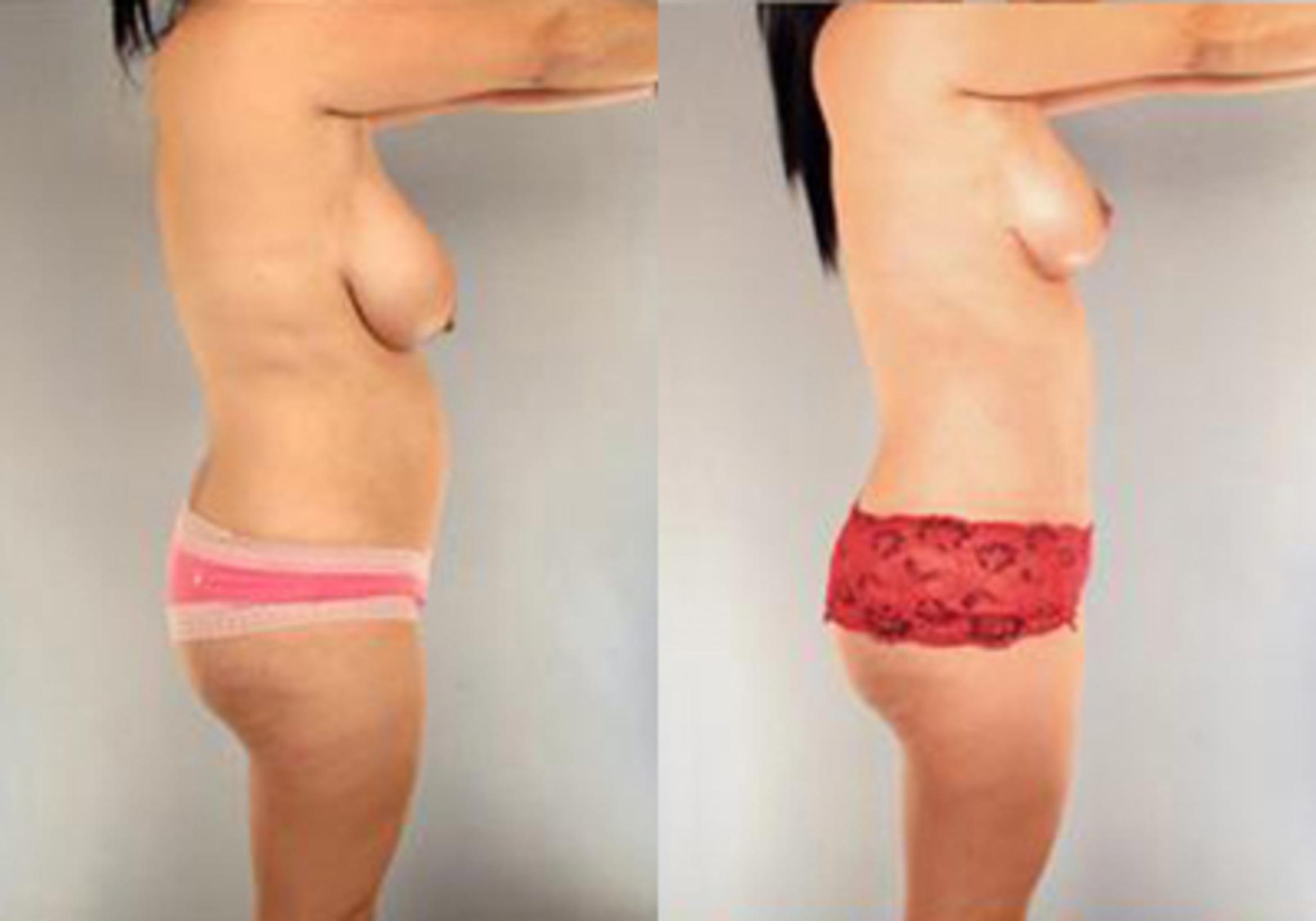 Before & After Mommy Makeover Case 103 View 2 View in Houston, TX