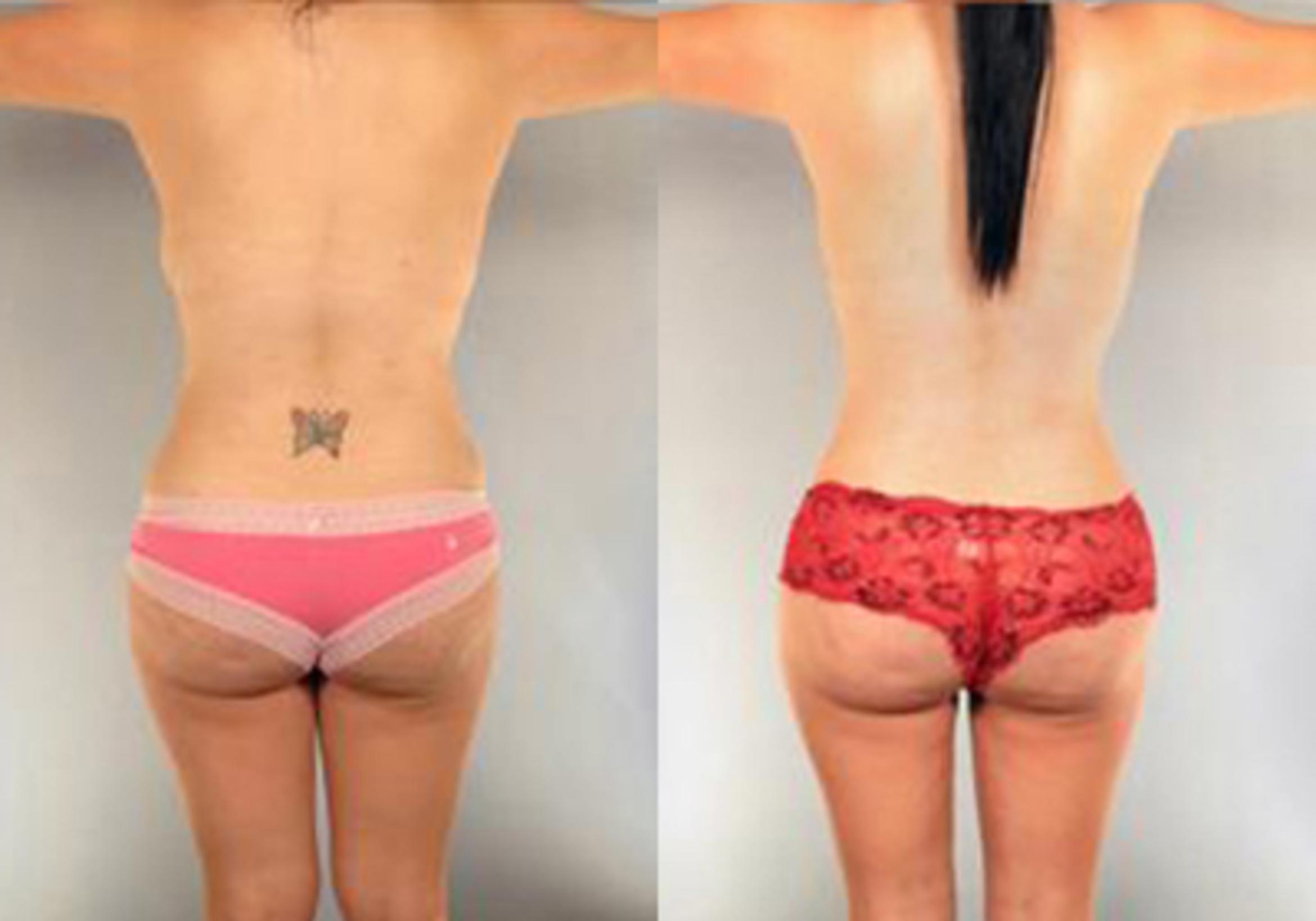 Before & After Mommy Makeover Case 103 View 3 View in Houston, TX