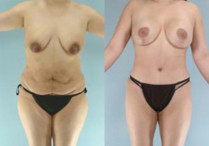 Before & After Mommy Makeover Case 104 View 1 View in Houston, TX