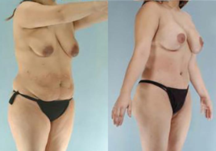 Before & After Mommy Makeover Case 104 View 2 View in Houston, TX