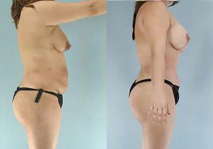 Before & After Mommy Makeover Case 104 View 3 View in Houston, TX