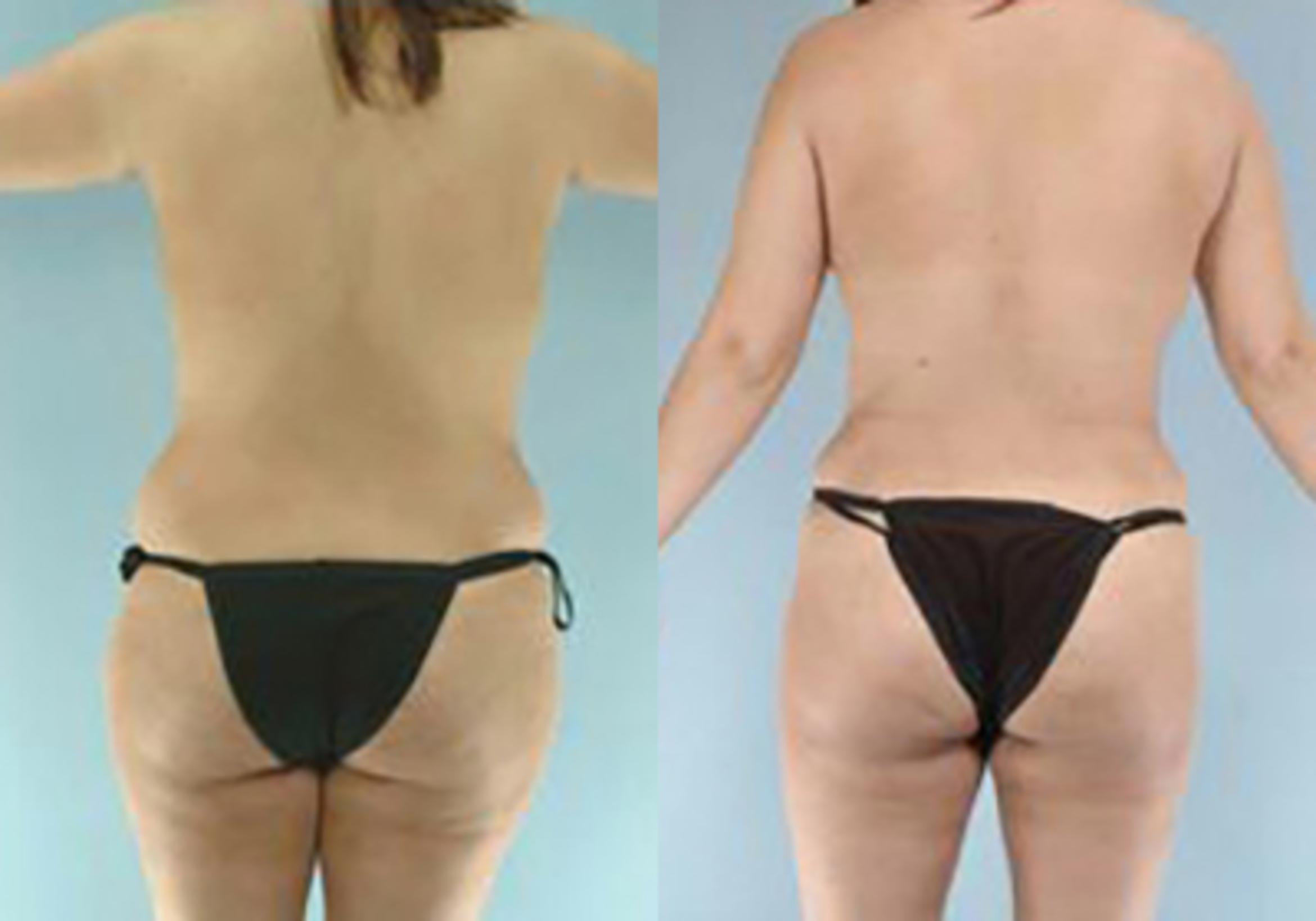 Before & After Mommy Makeover Case 104 View 4 View in Houston, TX