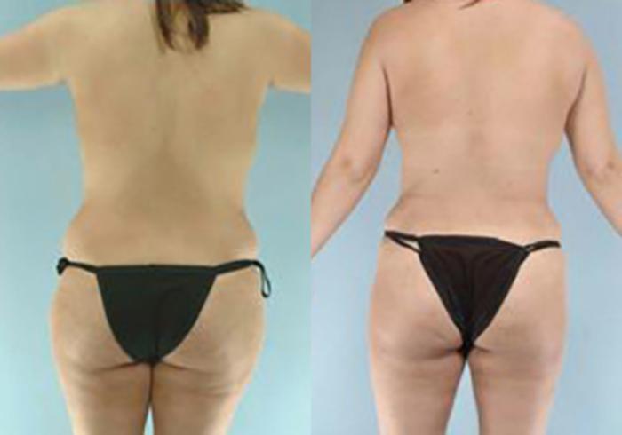 Before & After Mommy Makeover Case 104 View 4 View in Houston, TX