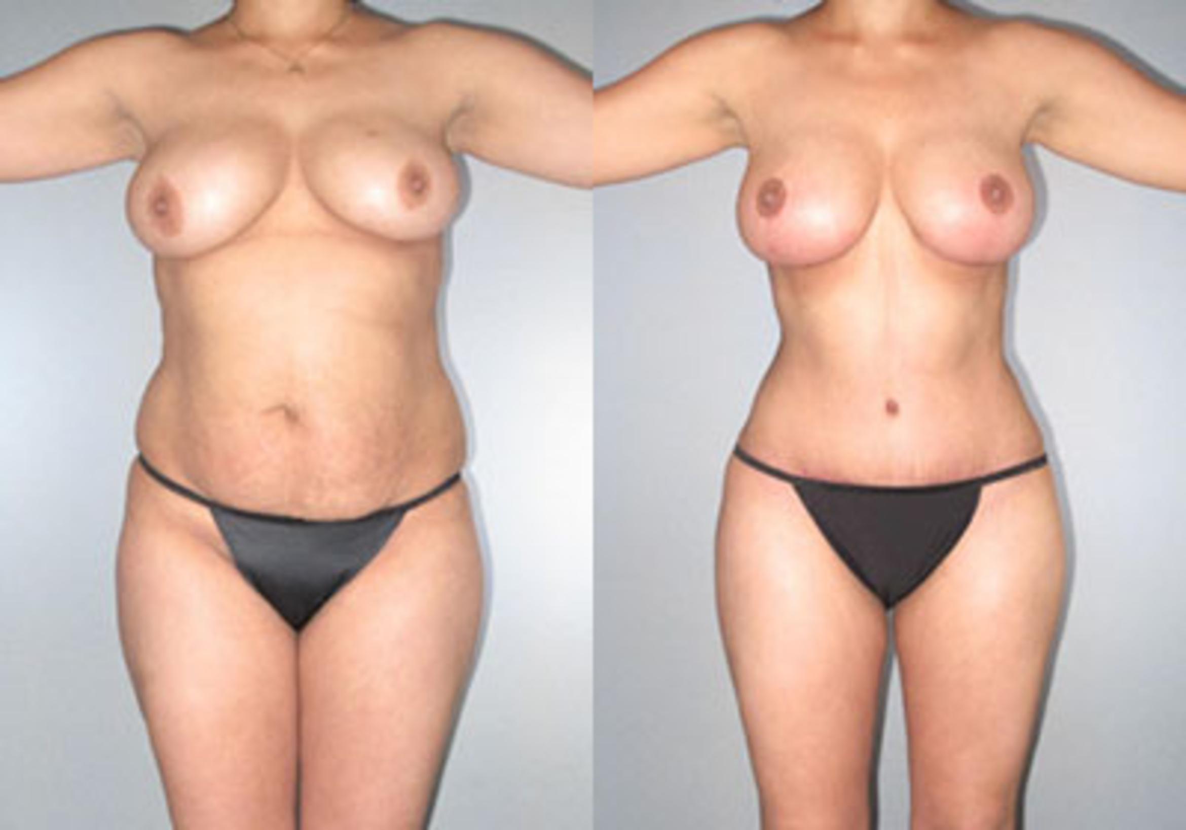 Before & After Mommy Makeover Case 118173 View 1 View in Houston, TX