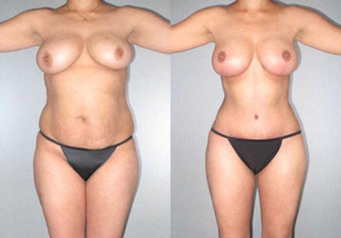 Before & After Mommy Makeover Case 118173 View 1 View in Houston, TX