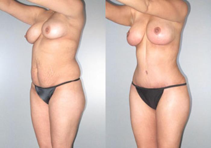 Before & After Mommy Makeover Case 118173 View 2 View in Houston, TX