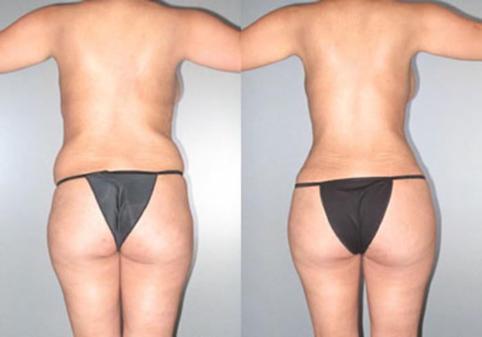 Before & After Mommy Makeover Case 118173 View 3 View in Houston, TX