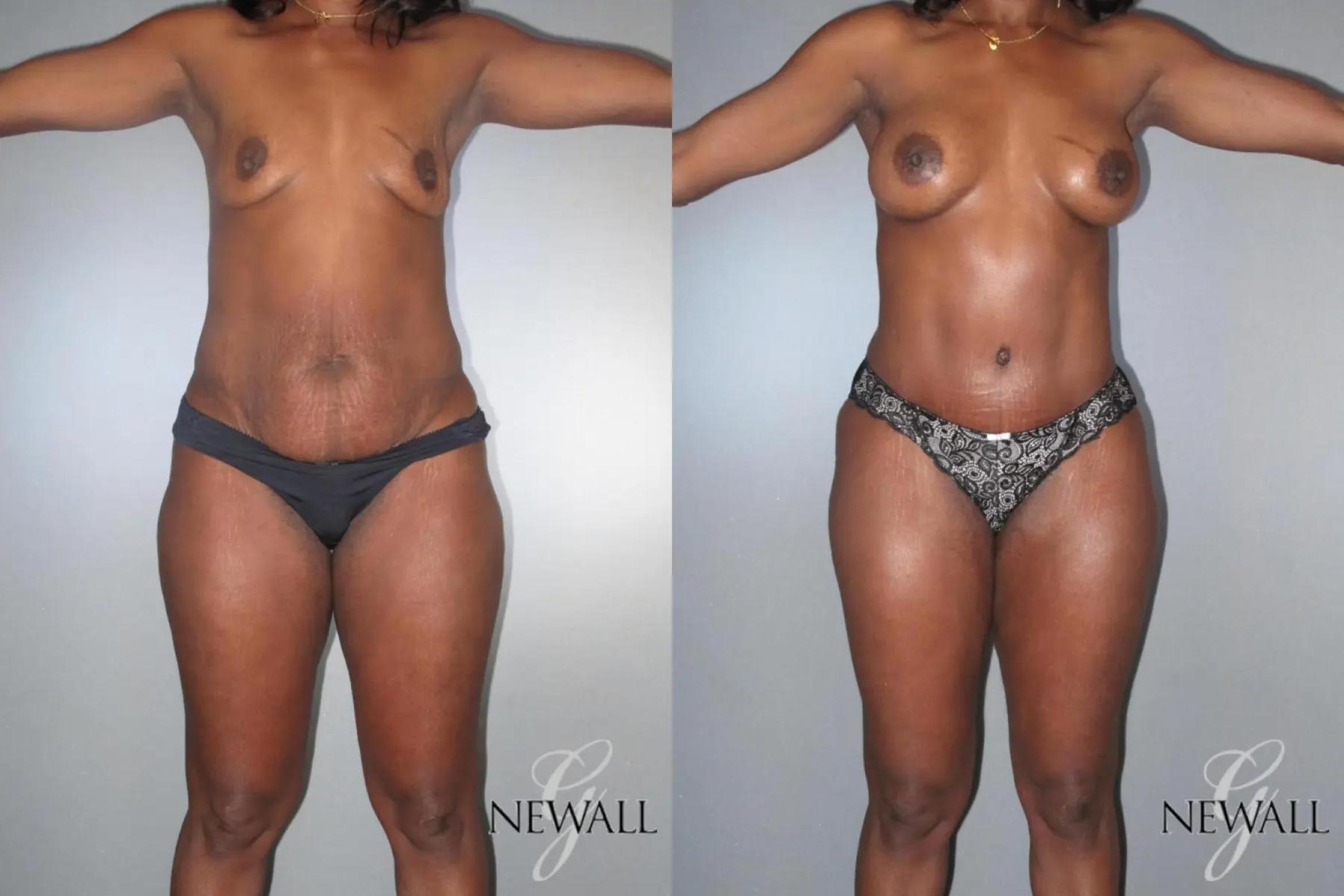 Before & After Mommy Makeover Case 17028 View 1 View in Houston, TX