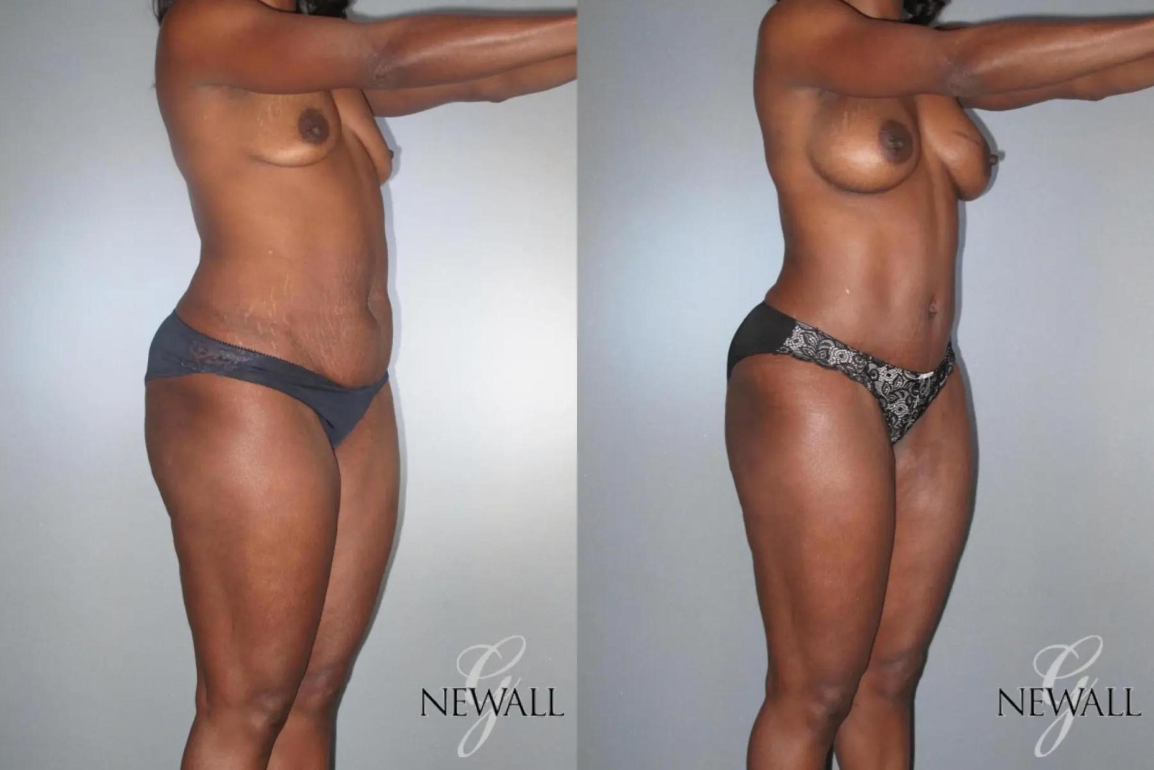 Before & After Mommy Makeover Case 17028 View 2 View in Houston, TX
