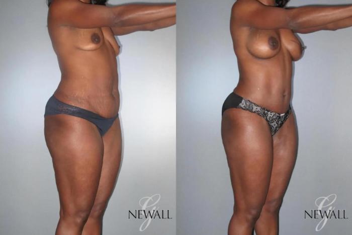 Before & After Mommy Makeover Case 17028 View 2 View in Houston, TX