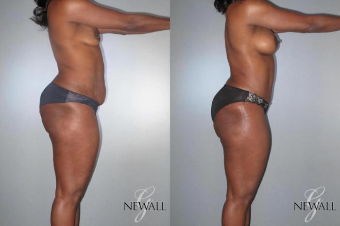 Before & After Mommy Makeover Case 17028 View 3 View in Houston, TX