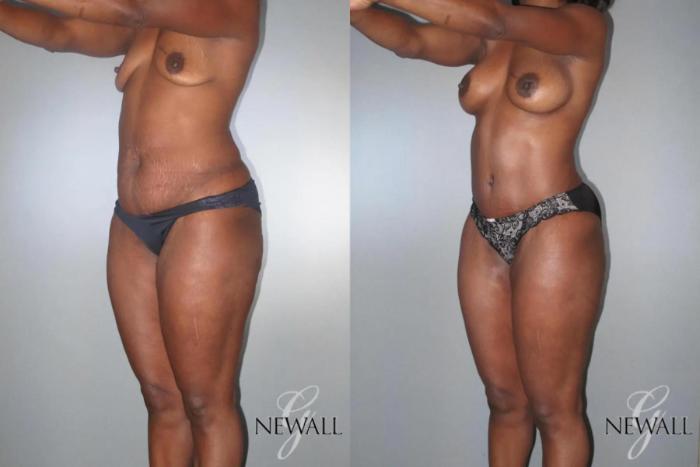 Before & After Mommy Makeover Case 17028 View 4 View in Houston, TX