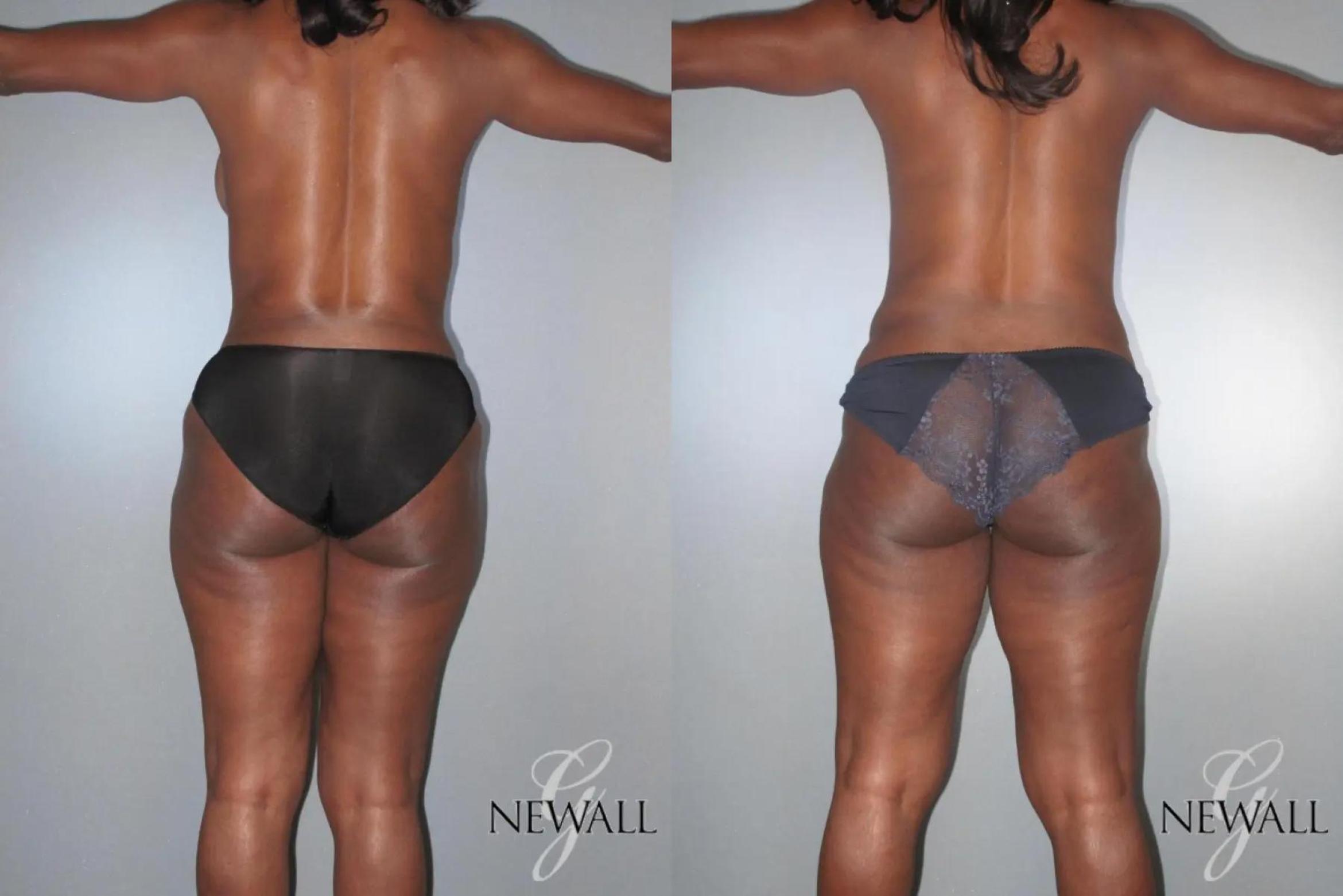 Before & After Mommy Makeover Case 17028 View 5 View in Houston, TX