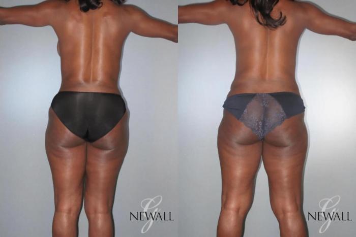 Before & After Mommy Makeover Case 17028 View 5 View in Houston, TX