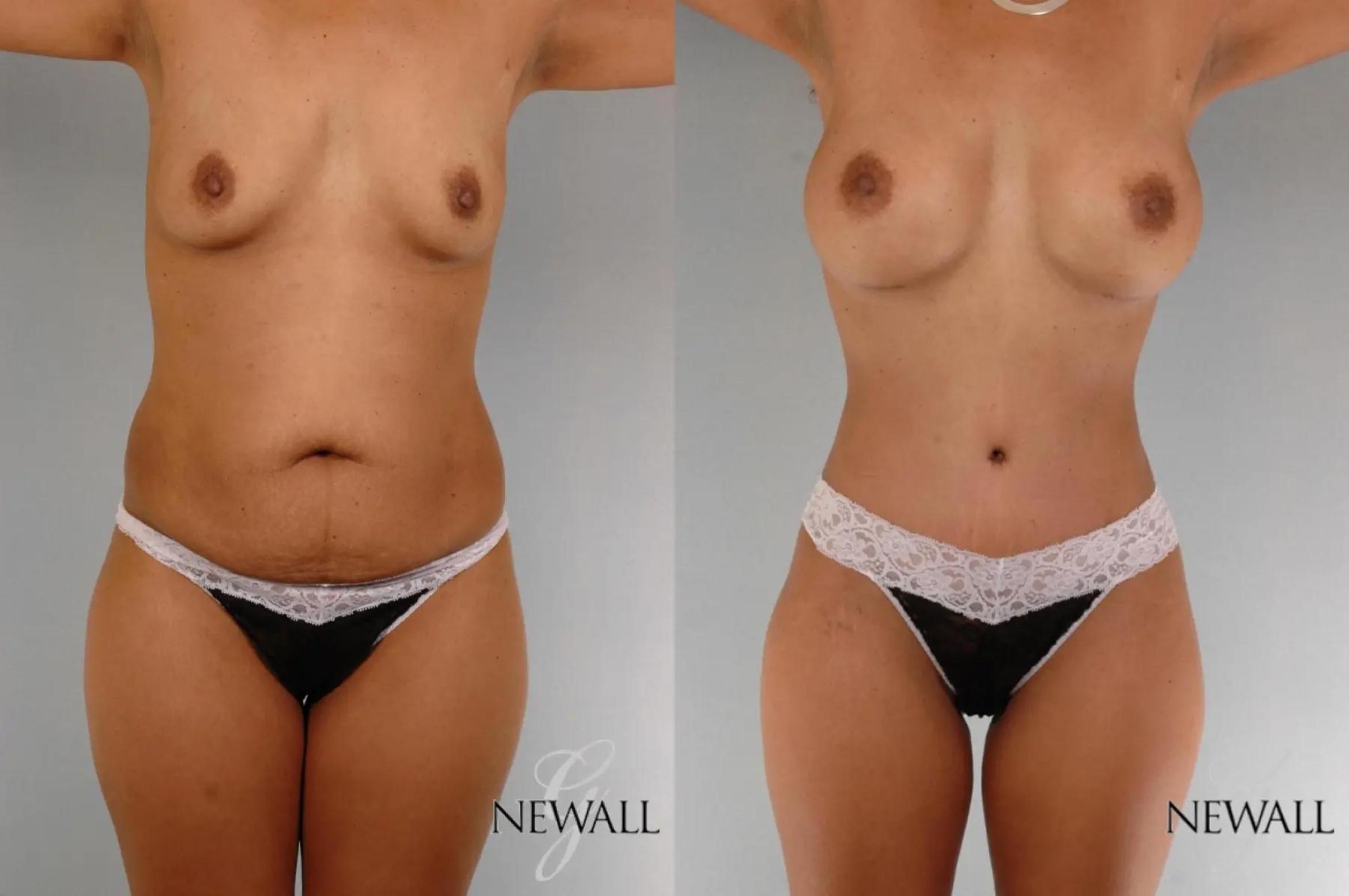 Before & After Mommy Makeover Case 17763 View 1 View in Houston, TX