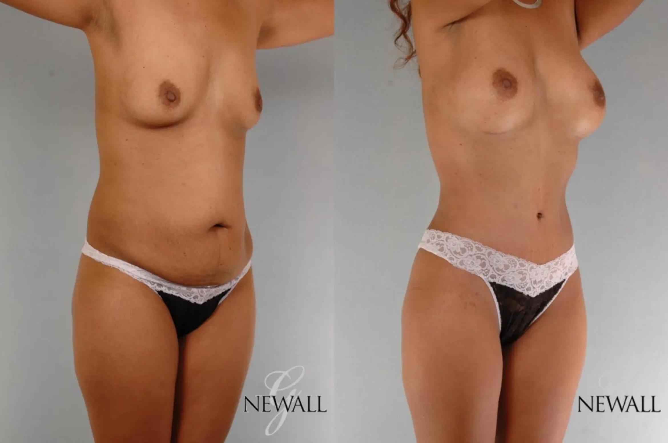 Before & After Mommy Makeover Case 17763 View 2 View in Houston, TX