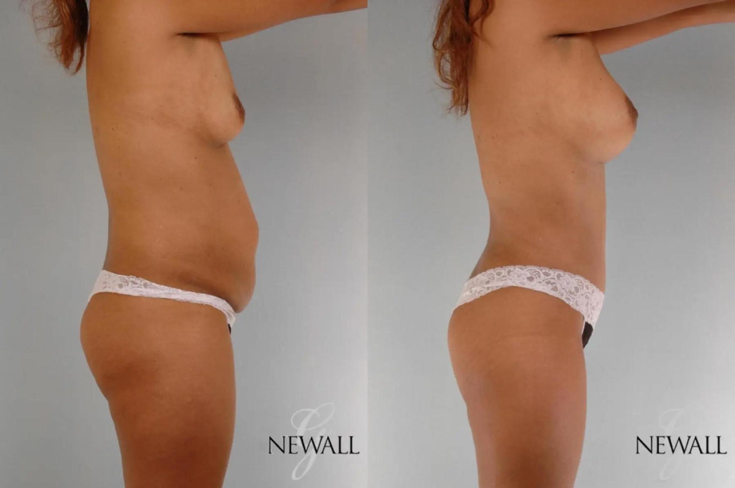 Before & After Mommy Makeover Case 17763 View 3 View in Houston, TX