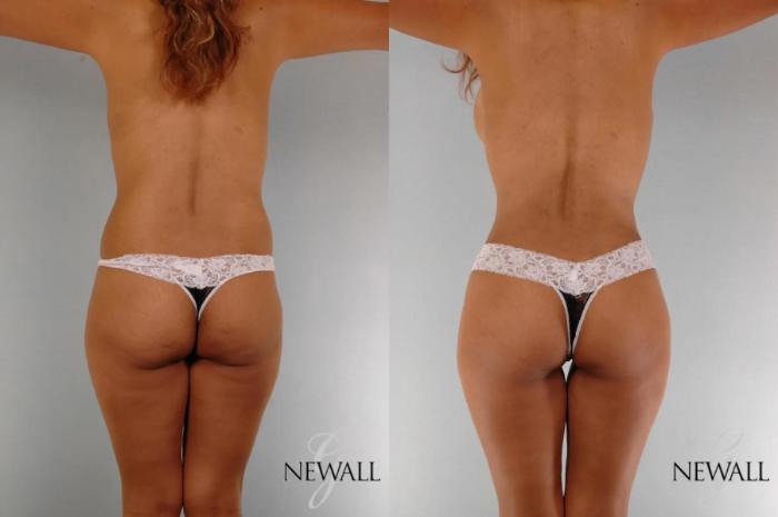 Before & After Mommy Makeover Case 17763 View 4 View in Houston, TX
