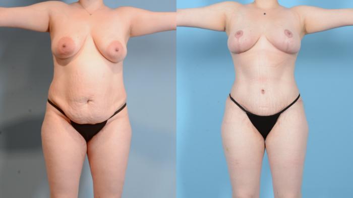 Before & After Mommy Makeover Case 18128 Front View in Houston, TX