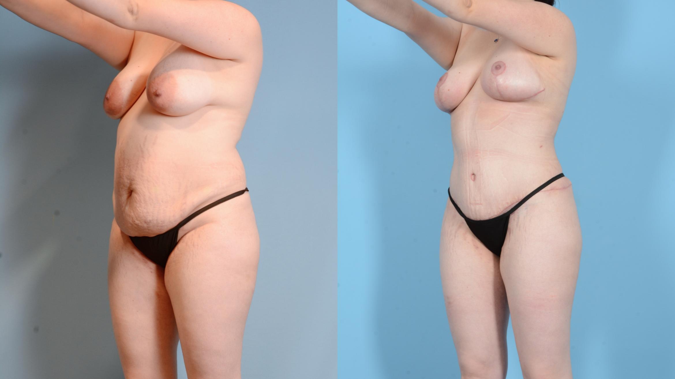 Before & After Mommy Makeover Case 18128 Left Oblique View in Houston, TX