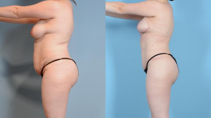 Before & After Mommy Makeover Case 18128 Left Side View in Houston, TX